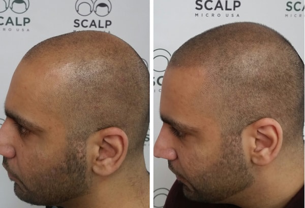 Alopecia